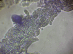 皮膚糸状菌症とマラセチア性皮膚炎も合併